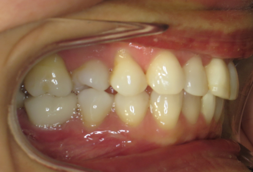 2 Right buccal in occlusion 