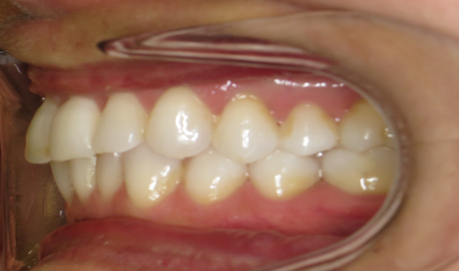 3 Left buccal in occlusion 