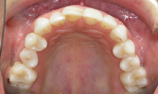 4 Occlusal upper 