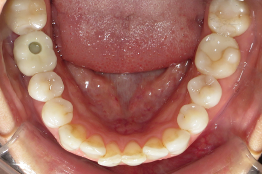 5 Occlusal lower 