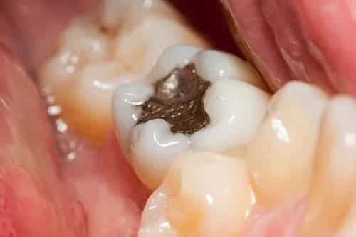 Changes to the use of dental amalgam