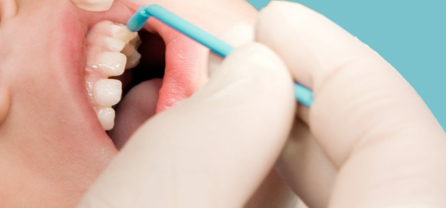 Proposed NHS Contract Change: Fluoride Varnish Applications by Dental Nurses