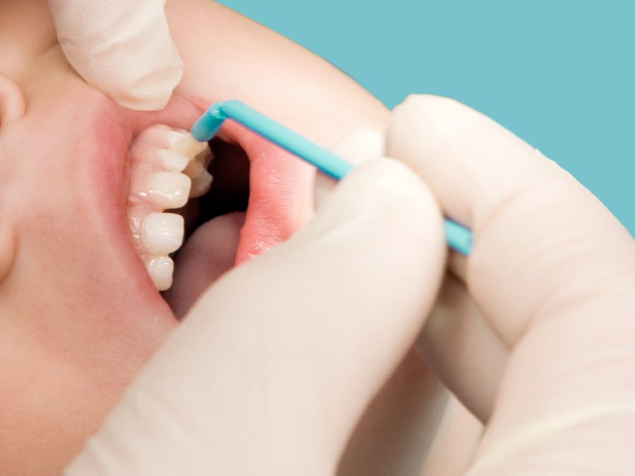 Proposed NHS Contract Change: Fluoride Varnish Applications by Dental Nurses