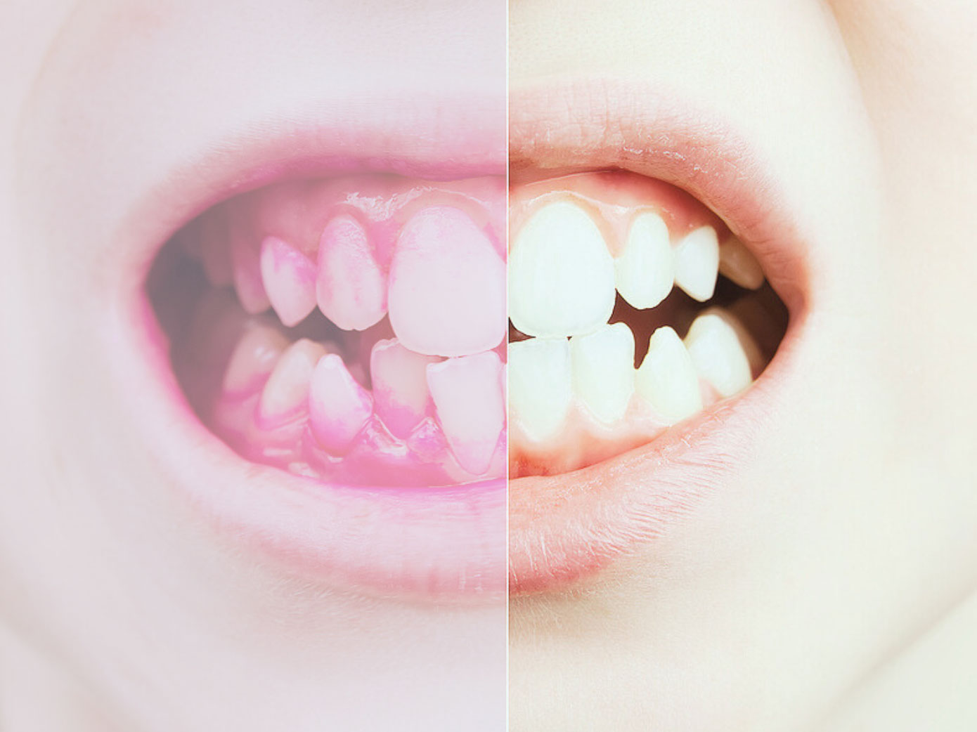 plaque indices course dental nurses 2024